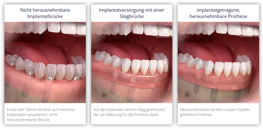 Herausnehmbare, implantatgetragene Prothese oder fest verschraubte Zahnreihe bei vollständig zahnlosem Kiefer.